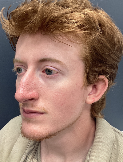 Rhinoplasty 2 Before Image