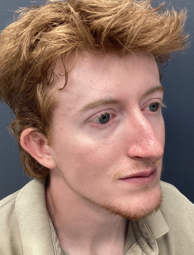 Rhinoplasty 2 Before Image