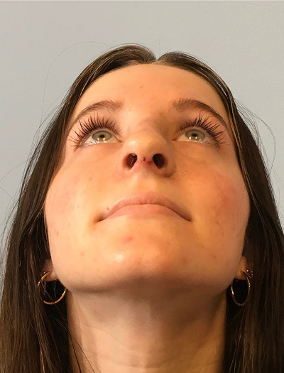 Rhinoplasty 3 After Image