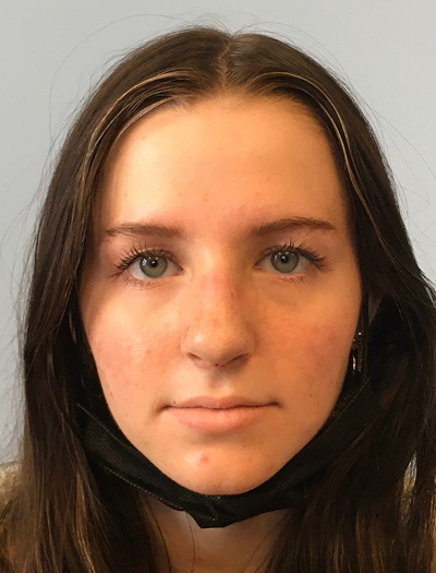 Rhinoplasty 3 After Image