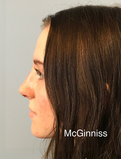 Rhinoplasty 3 After Image