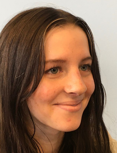 Rhinoplasty 3 After Image