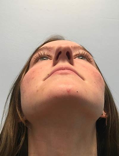 Rhinoplasty 3 Before Image