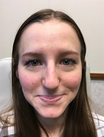Rhinoplasty 3 Before Image