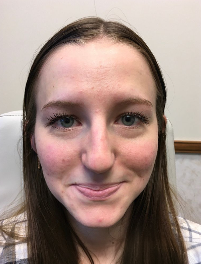 Rhinoplasty 3 Before Image