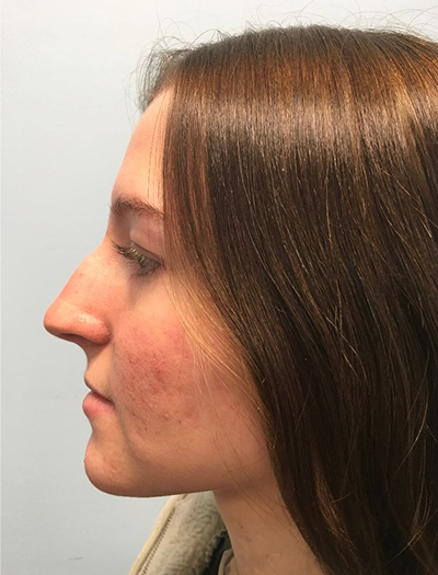 Rhinoplasty 3 Before Image
