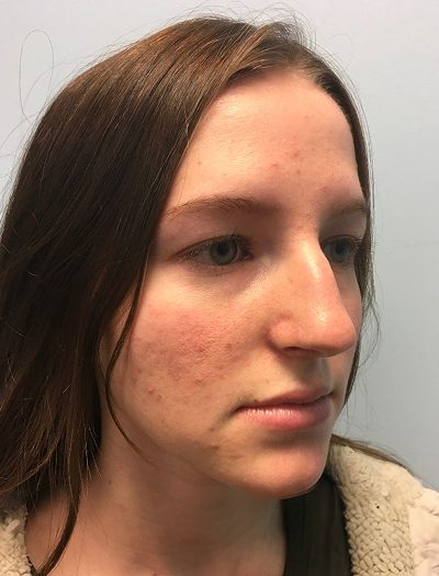 Rhinoplasty 3 Before Image