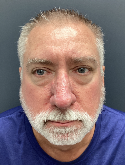 Rhinophyma 1 After Image