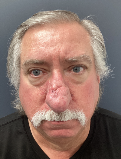Rhinophyma 1 Before Image