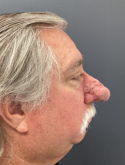 Rhinophyma 1 Before Image