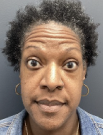 Botox 2 Before Image