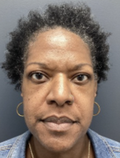 Botox 2 Before Image