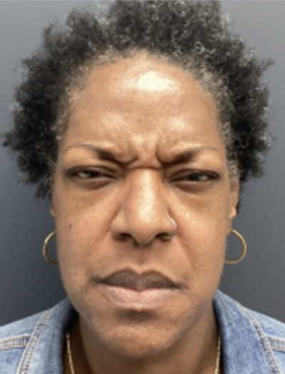 Botox 2 Before Image