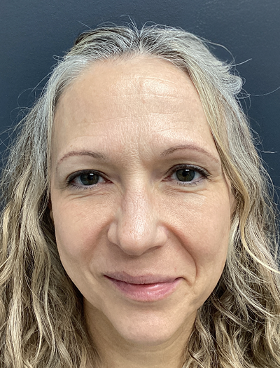 Botox & Brow Lift 1 After Image