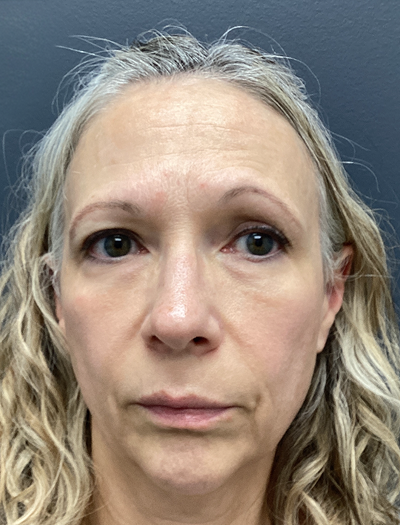 Botox & Brow Lift 1 Before Image
