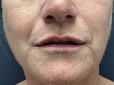 Lip Filler 1 After Image