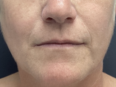 Lip Filler 1 Before Image
