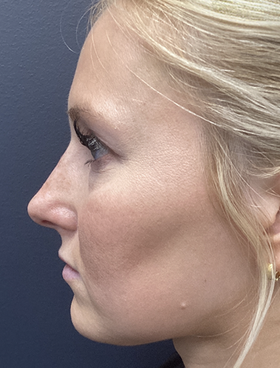 Liquid Rhinoplasty 1 After Image