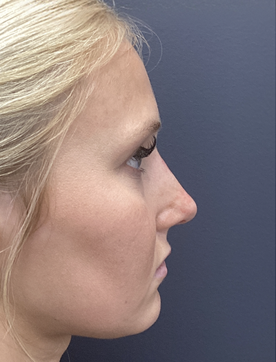 Liquid Rhinoplasty 1 After Image