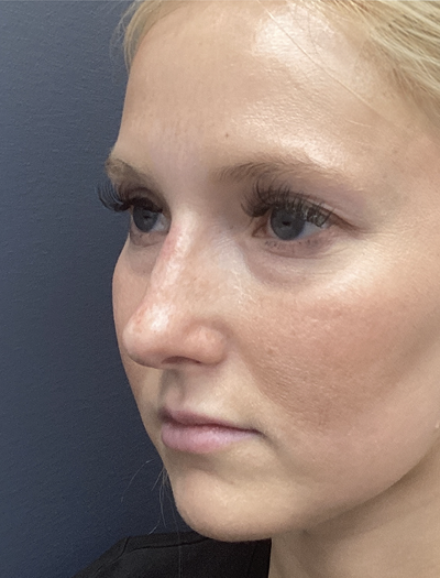Liquid Rhinoplasty 1 After Image