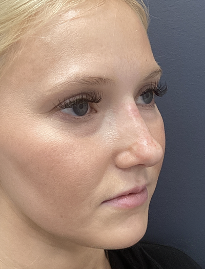 Liquid Rhinoplasty 1 After Image