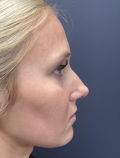 Liquid Rhinoplasty 1 Before Image