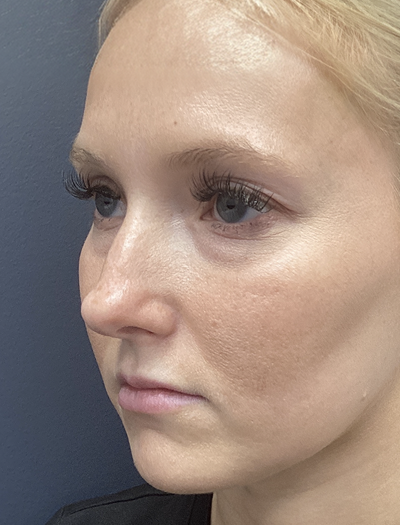 Liquid Rhinoplasty 1 Before Image