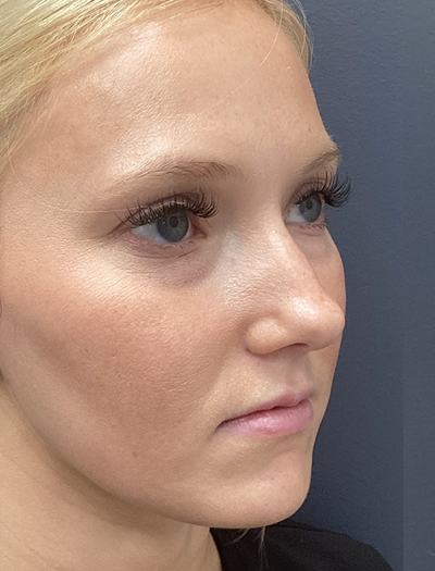 Liquid Rhinoplasty 1 Before Image