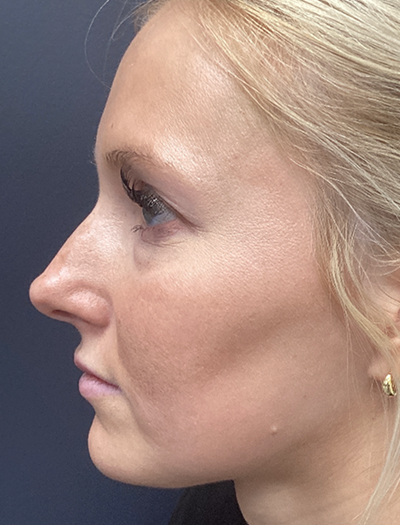 Liquid Rhinoplasty 1 Before Image