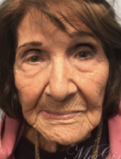 Facial Reconstruction 1 After Image