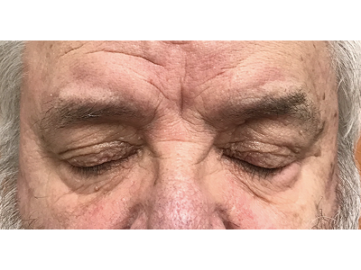 Lesion (Skin Tag) Removal 1 After Image