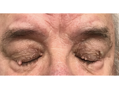 Lesion (Skin Tag) Removal 1 Before Image