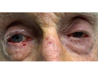 Lower Eyelid Reconstruction 1 After Image