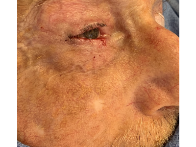Lower Eyelid Reconstruction 1 After Image