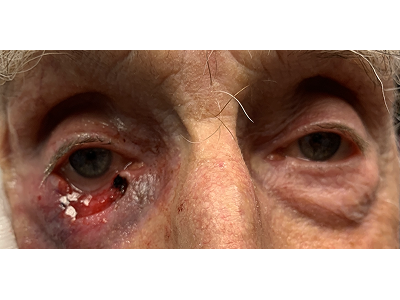 Lower Eyelid Reconstruction 1 Before Image