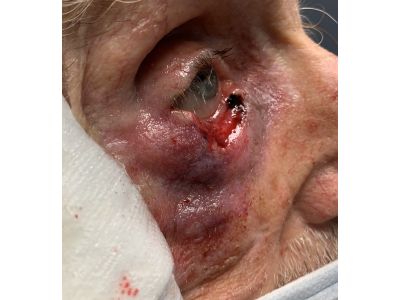 Lower Eyelid Reconstruction 1 Before Image