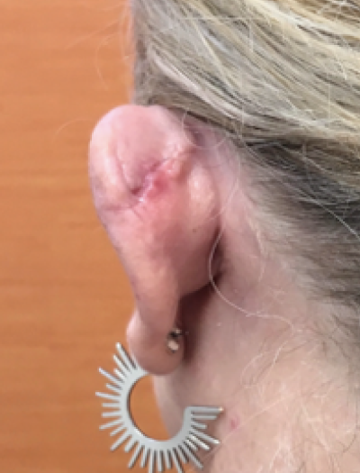 Ear Reconstruction 1 After Image