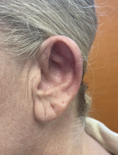 Ear Reconstruction 1 After Image