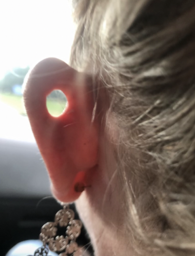 Ear Reconstruction 1 Before Image