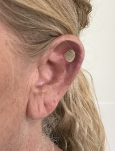 Ear Reconstruction 1 Before Image
