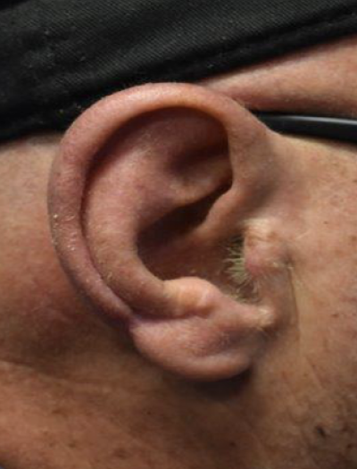 Ear Reconstruction 2 After Image