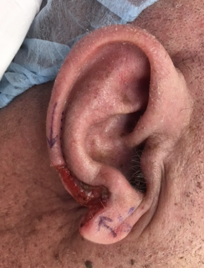 Ear Reconstruction 2 Before Image