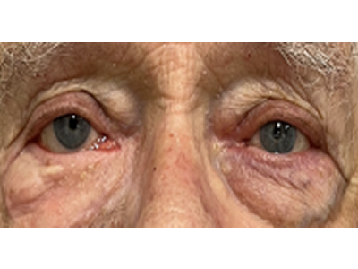 Ectropion Secondary to Scar Repair 1 After Image