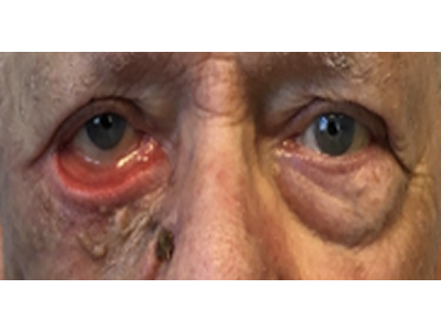 Ectropion Secondary to Scar Repair 1 Before Image