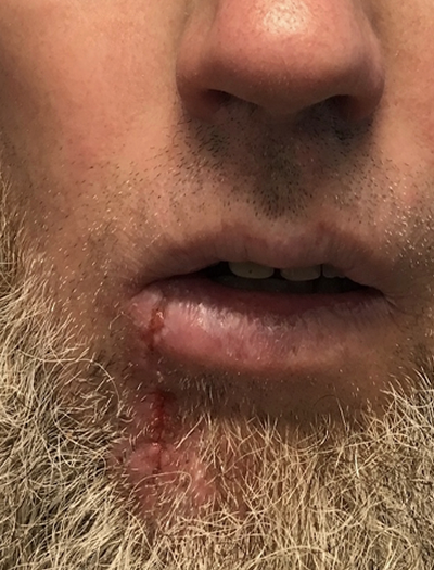 Lip Reconstruction 1 After Image