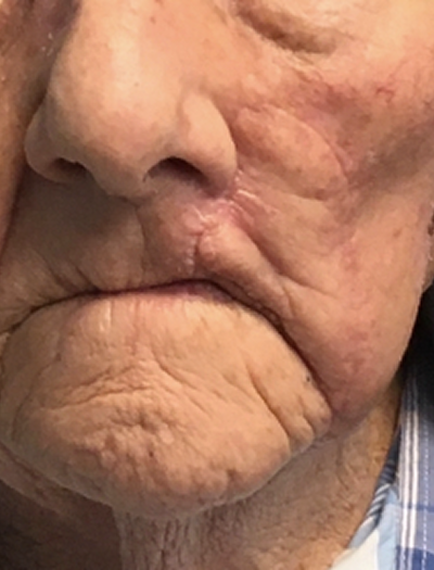 Lip Reconstruction 2 After Image