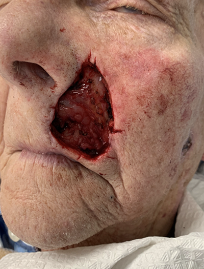 Lip Reconstruction 2 Before Image
