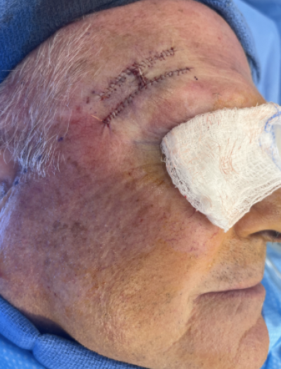 Skin Cancer Removal & Repair 1 After Image