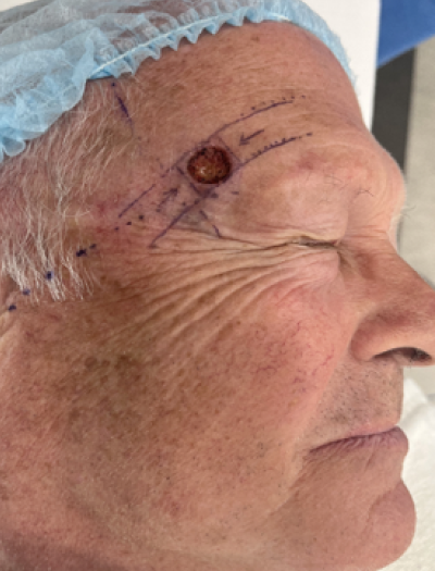 Skin Cancer Removal & Repair 1 Before Image