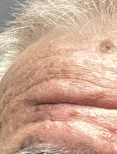 Skin Cancer Removal & Repair 2 After Image